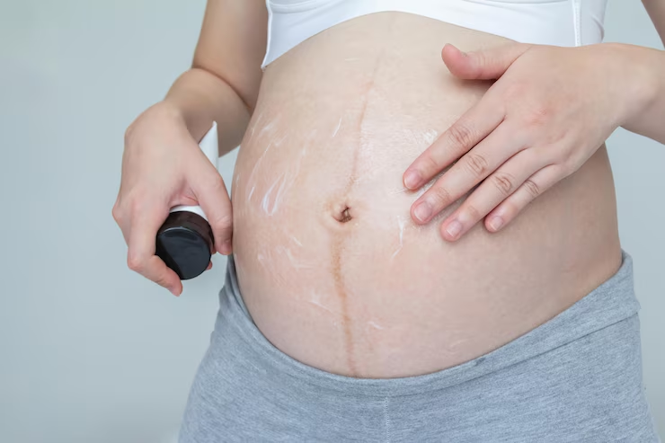 Body Care Secrets: Fade Stretch Marks and Boost Elasticity with Neutriherbs’ Peptide Cream