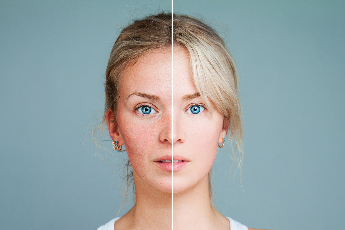 Do You Have Stubborn Acne? Eliminate It with These 5 Organic Therapies