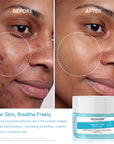Salicylic Acid Face Cream for Acne & Oil Control