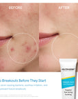 Salicylic Acid Spot Treatment for Acne & Blemishes