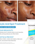 Salicylic Acid Spot Treatment for Acne & Blemishes