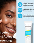 Salicylic Acid Spot Treatment for Acne & Blemishes