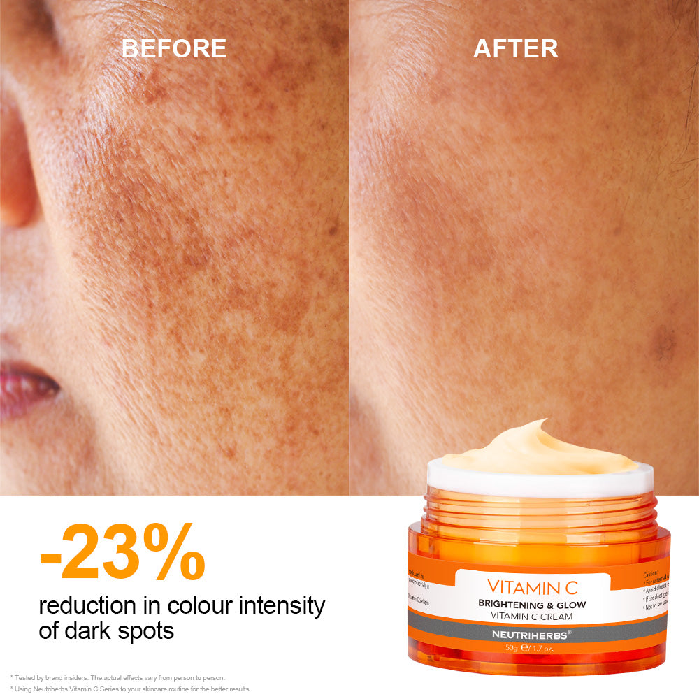 vitamin c help to reduce the colour intensity of dark spots