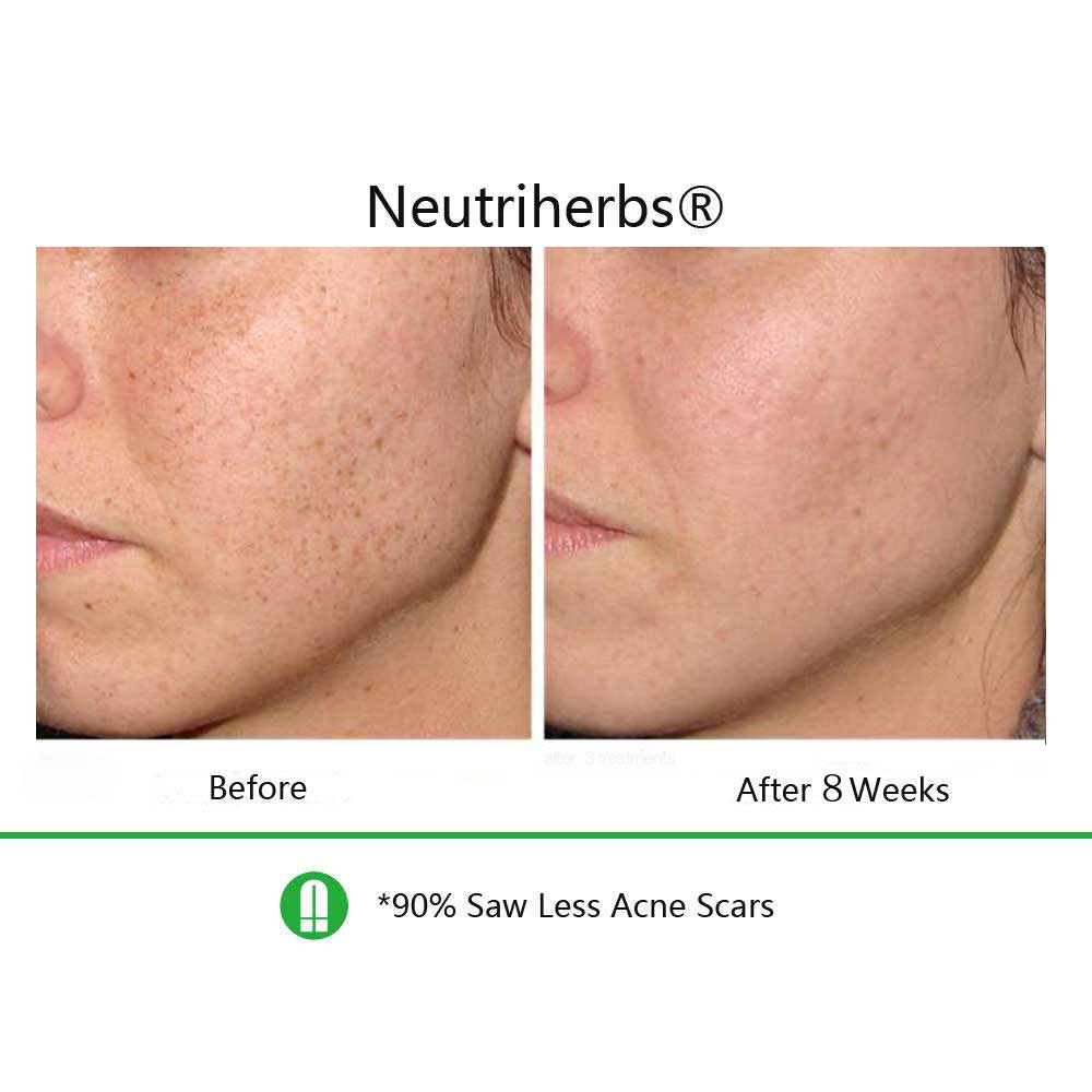 Vitamin-C-Serum-sun spots-before-and-after