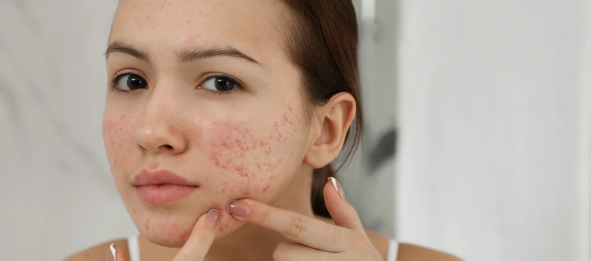 Difference between Purge and Acne