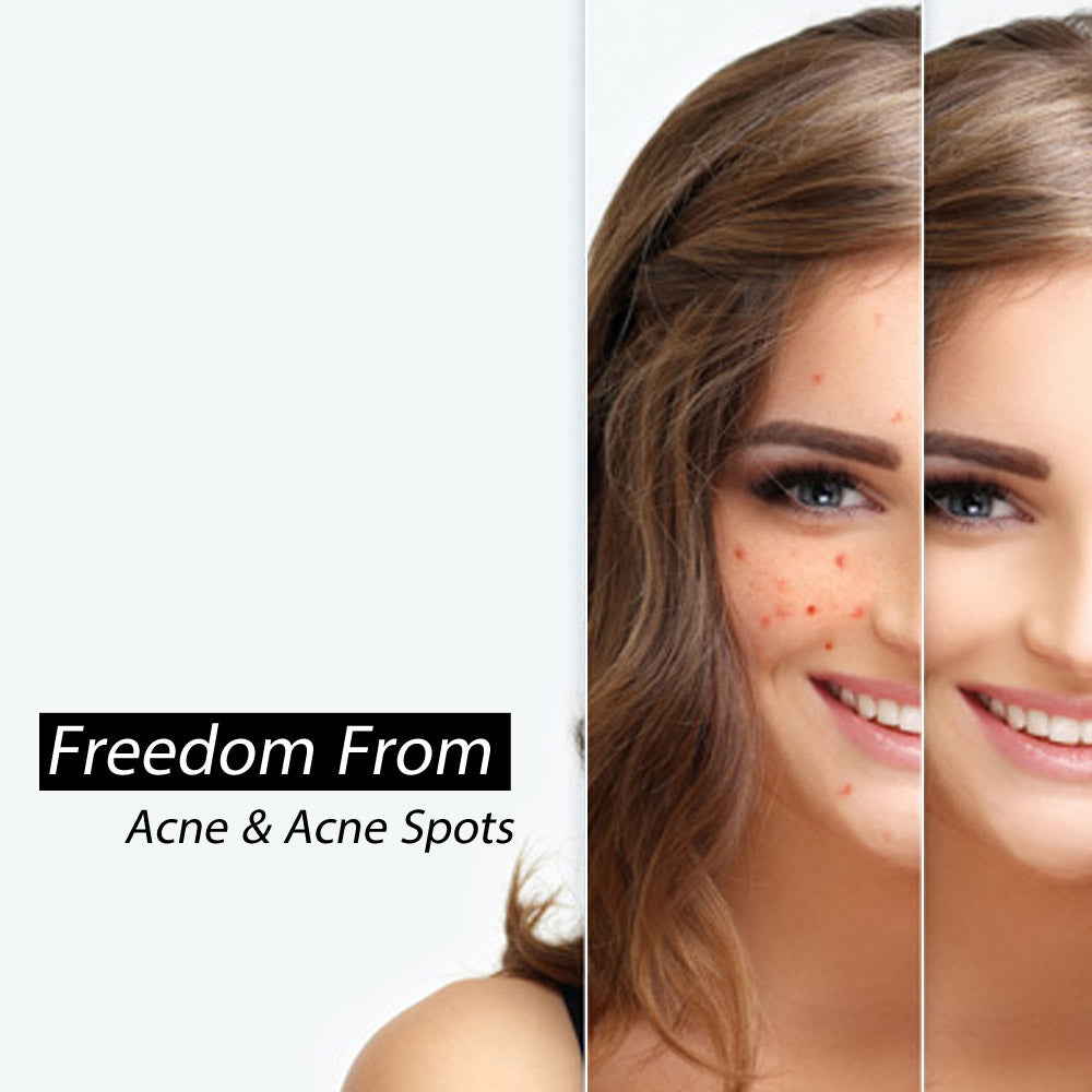 The Very Best Acne Tips You Must Be Know