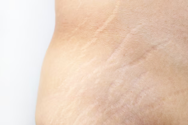 Say Goodbye to Stretch Marks: The Ultimate Guide to Finding the Perfect Stretch Mark Cream