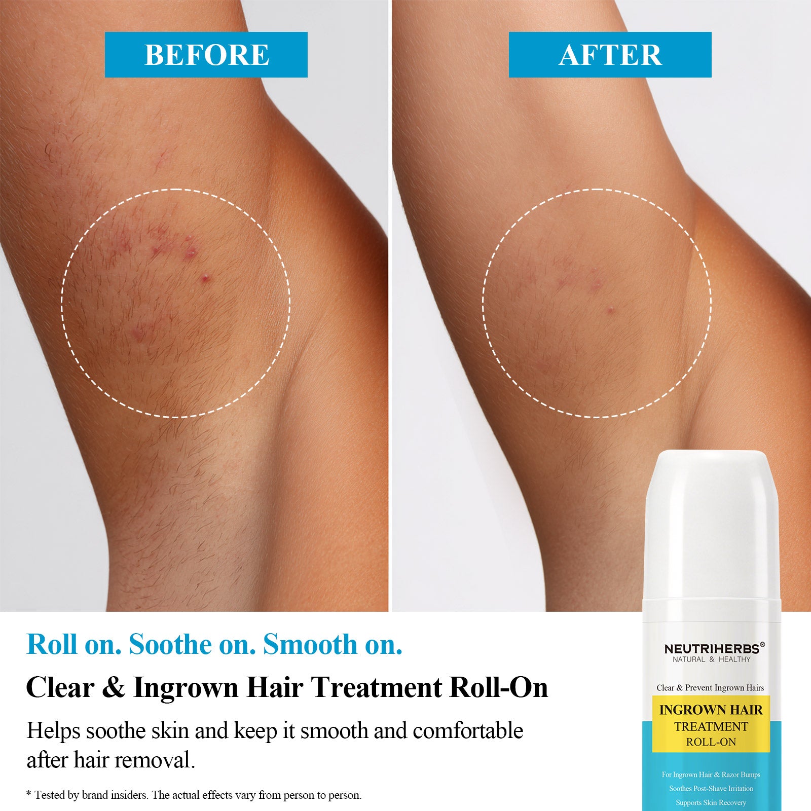 Clear &amp; Prevent Ingrown Hairs Ingrown Hair Treatment Roll-On