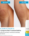 Clear & Prevent Ingrown Hairs Ingrown Hair Treatment Roll-On