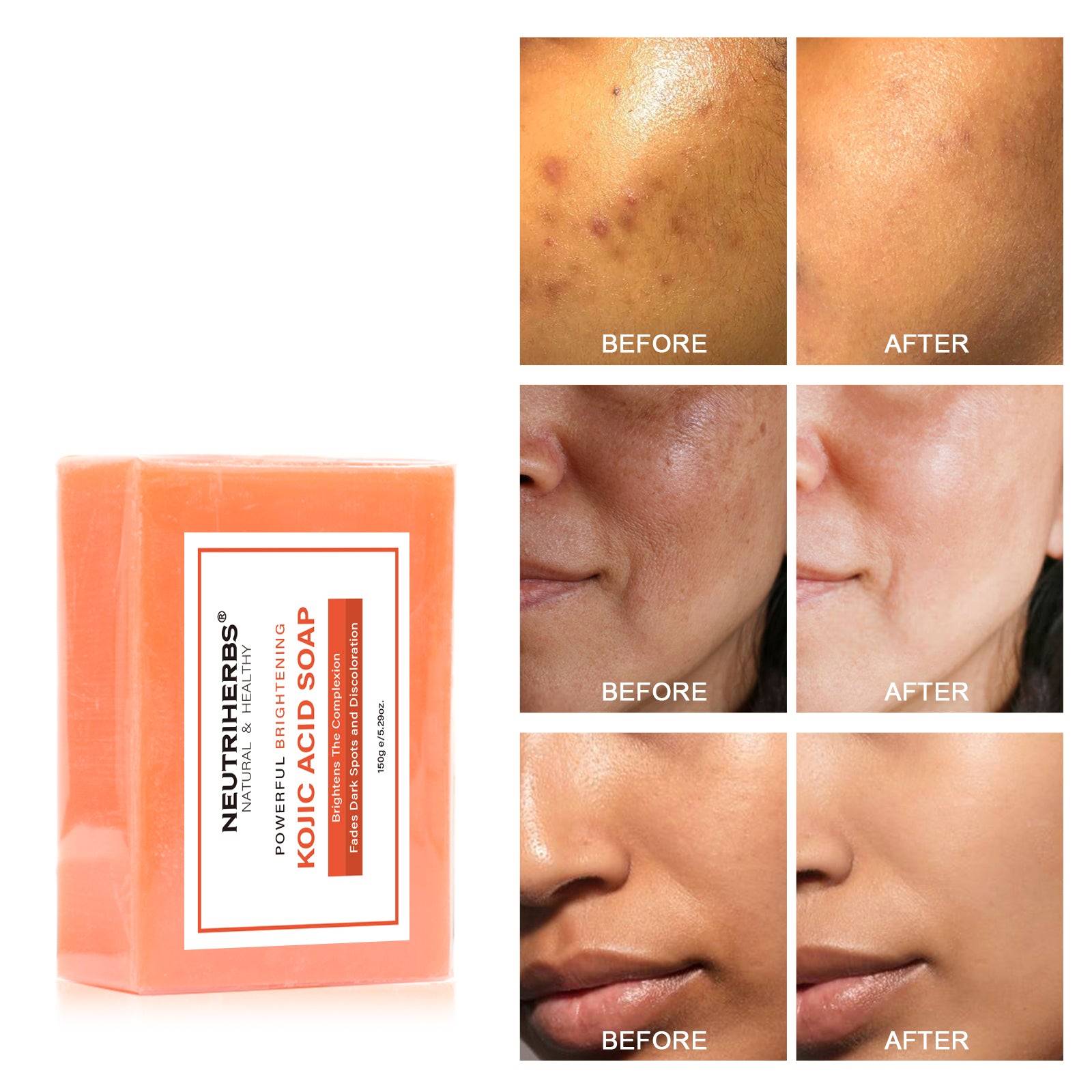 Kojic Acid Skin Brightening Soap