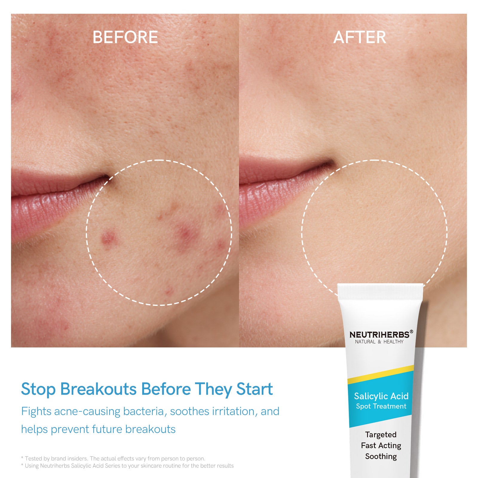 Salicylic Acid Spot Treatment for Acne &amp; Blemishes