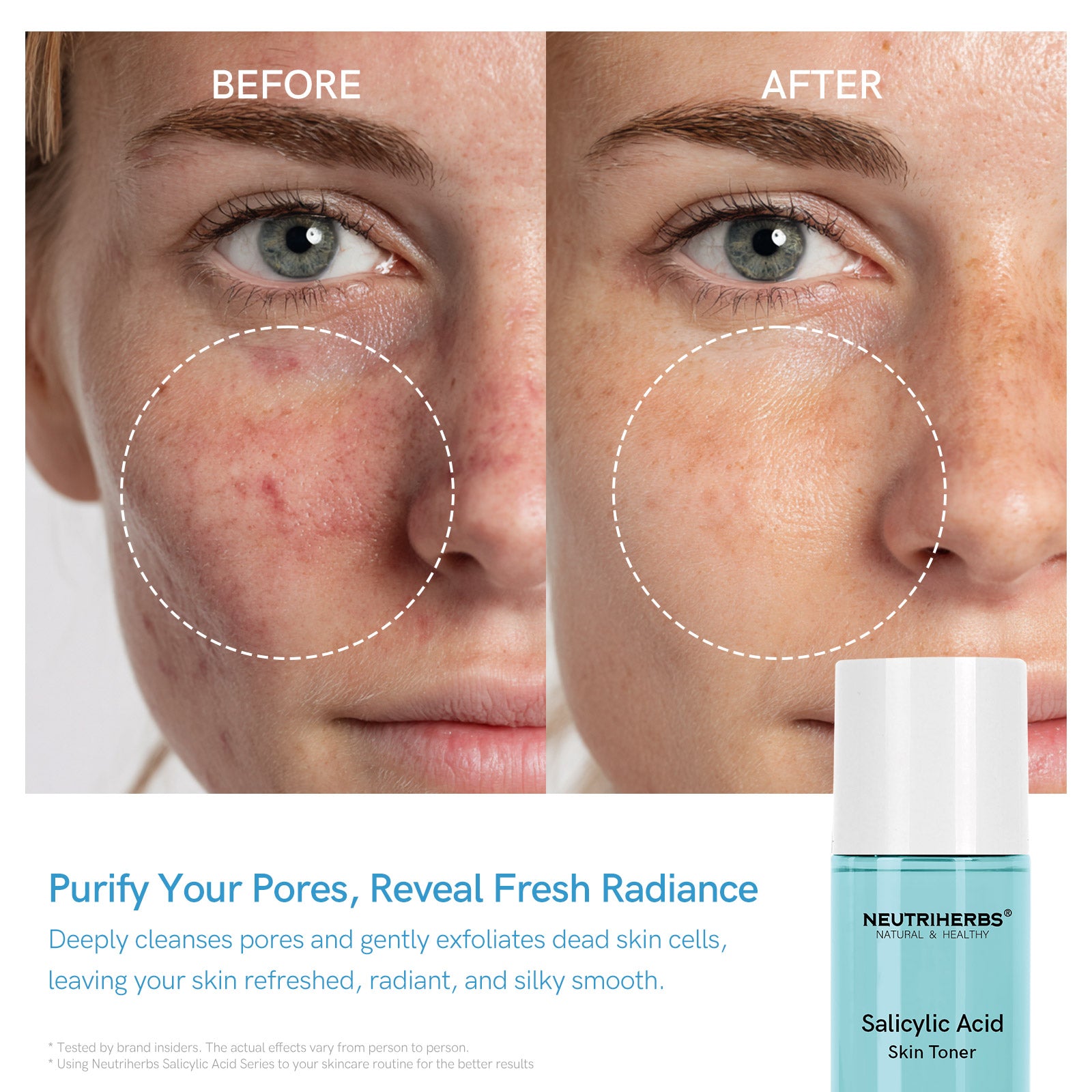 Salicylic Acid Toner for Acne &amp; Pores