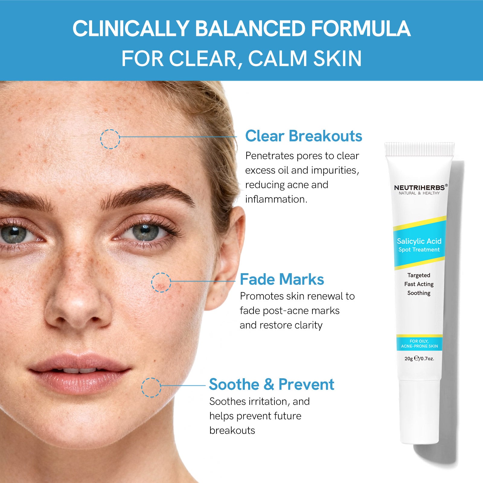 Salicylic Acid Spot Treatment for Acne &amp; Blemishes