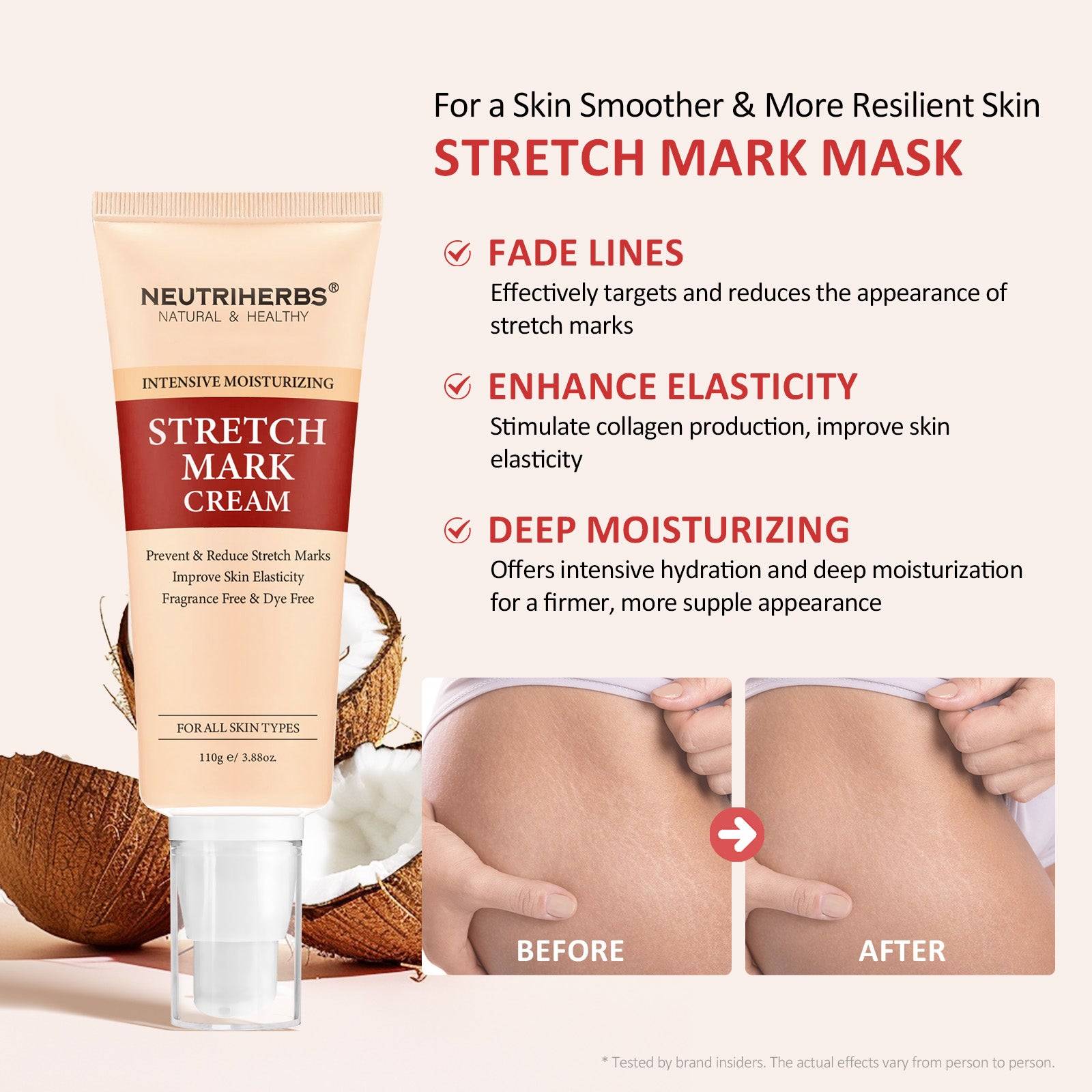 Body Stretch Mark Cream For A Smoother and Resilient Skin