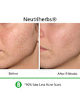 Vitamin-C-Serum-sun spots-before-and-after